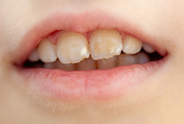 Brown stains on teeth