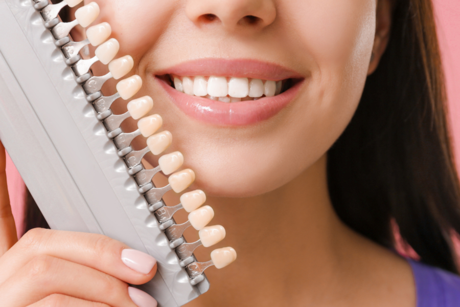 Licówki kompozytowe na zęby – zalety i wady licówek, ile kosztują licówki na zęby, czy warto zdecydować się na założenie licówek kompozytowych?