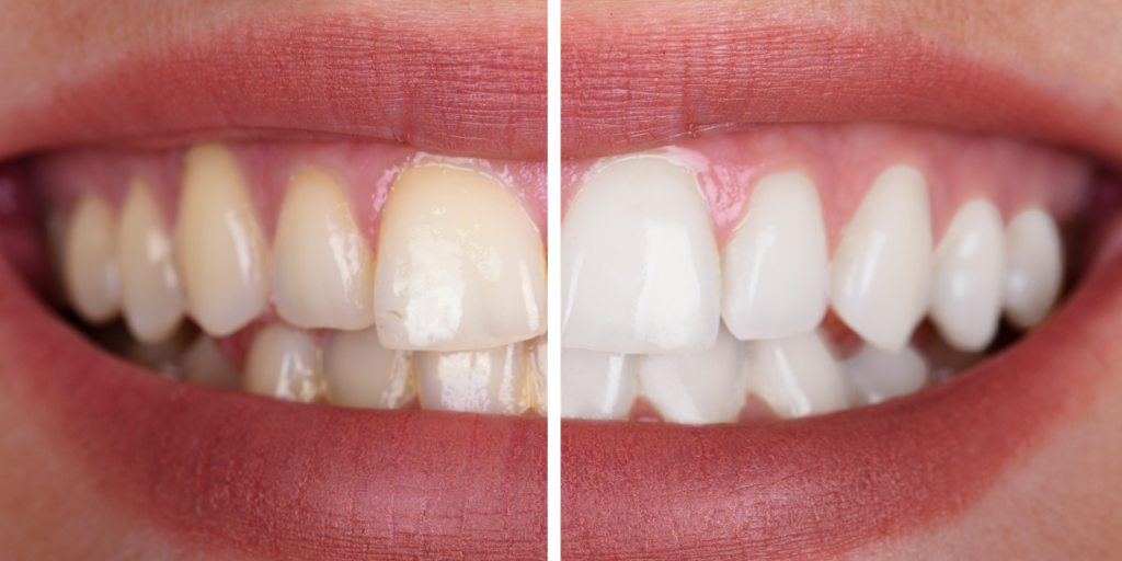 whitening