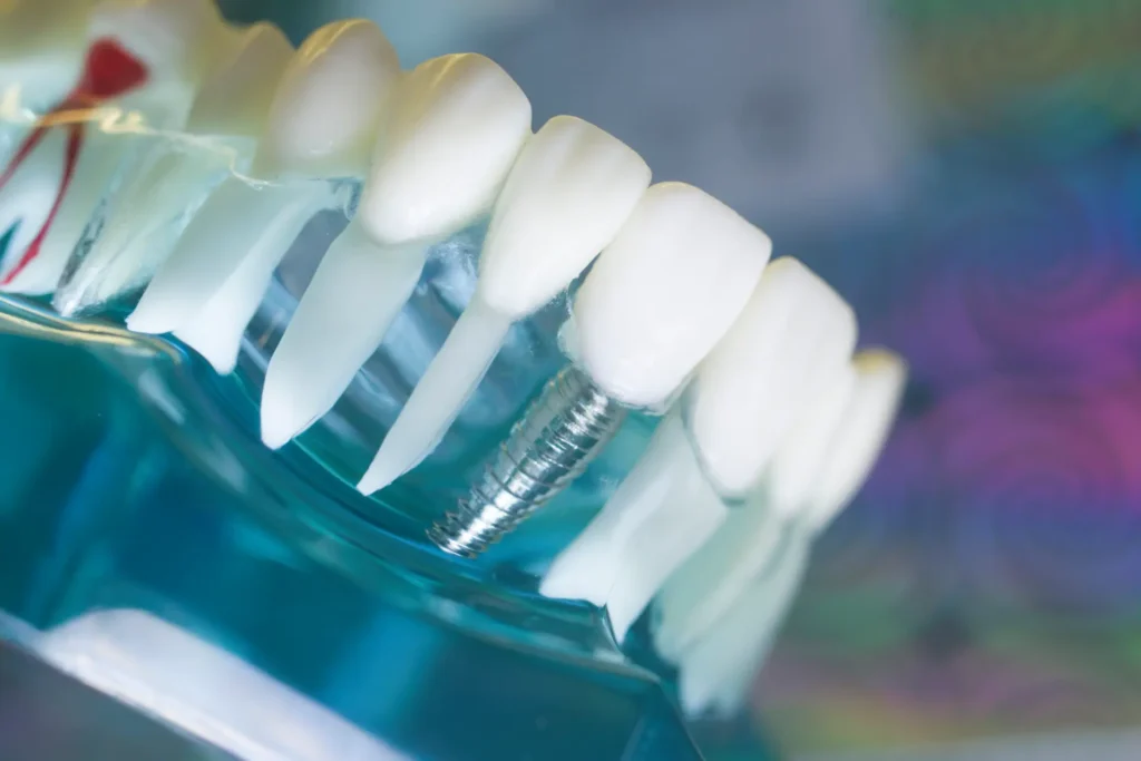 Implant vs proteza – czym się różnią?